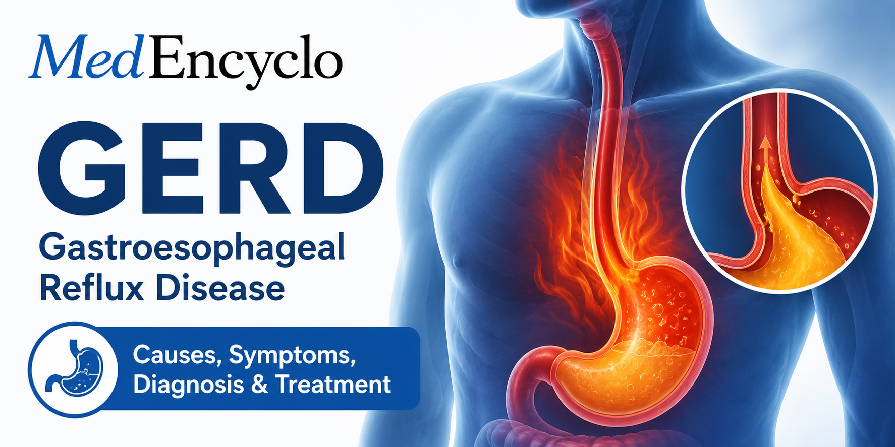 Gastroesophageal Reflux Disease