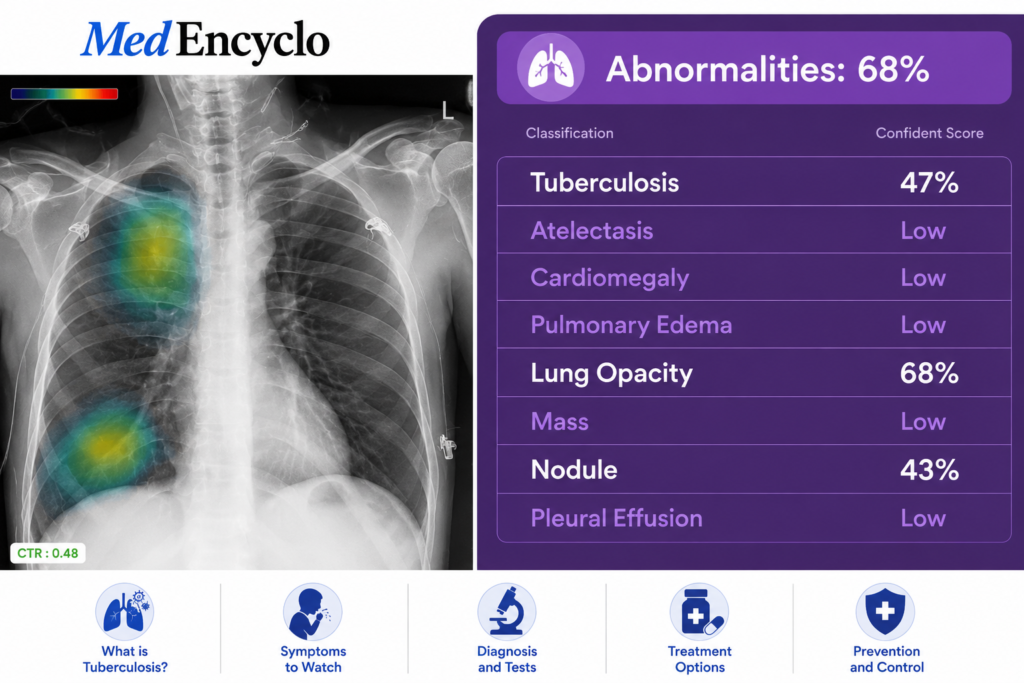 Tuberculosis